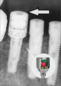 Миниатюрный электромагнитный формирователь улучшает стабильность зубных имплантатов