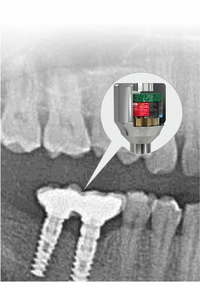 Влияние импульсного электромагнитного поля (PEMF) на стабильность зубных имплантатов: рандомизированное контролируемое клиническое исследование