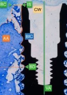 Periodontally diseased tooth